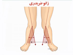 زانوی ضربدری, صحت بخش, ارتوپدی فنی, اورتز, ارنز, ارتوپدی