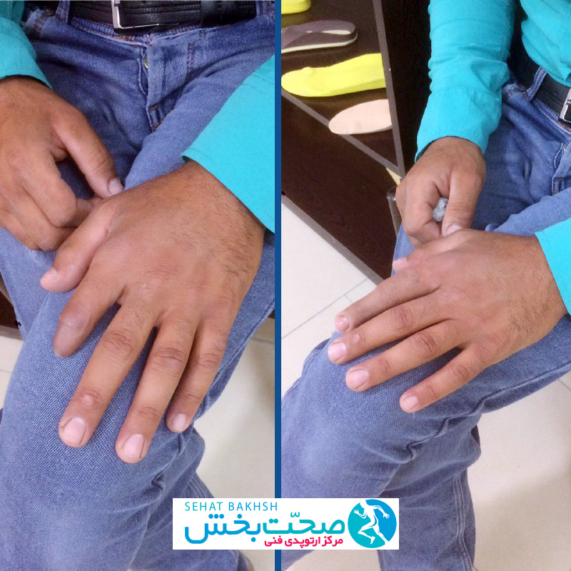 ساخت پروتز کاسموتیک انگشت چهار در کلینیک صحت بخش