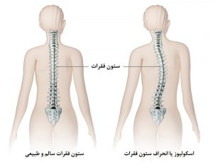 درمان اسکولیوز