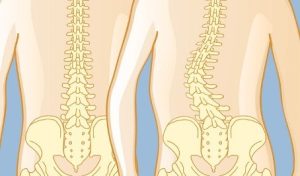 درمان انحراف ستون فقرات یا اسکولیوز